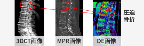 圧迫骨折時の3DCT画像、MPR画像、DE画像